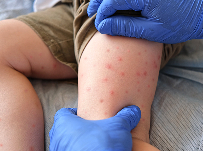 Gestion des peaux à tendance acnéique